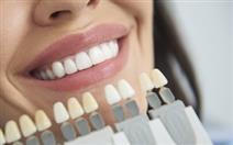 Branqueamento Dentário com Moldeiras + Destartarização por 89,90€ em Alcântara!