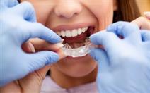 Branqueamento Dentário com Moldeiras + Destartarização por 89,90€ em Campo de Ourique